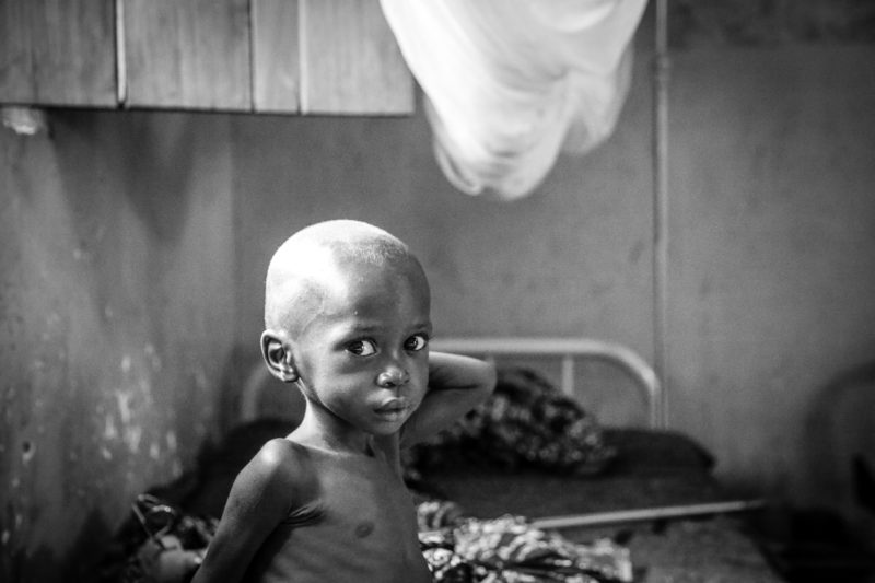 malnutrition tanzania baby